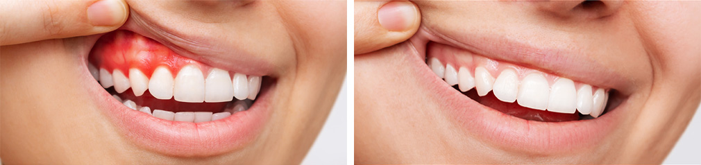 Gum Treatment Before & After
